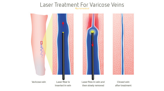 varicose veins treatment in dubai